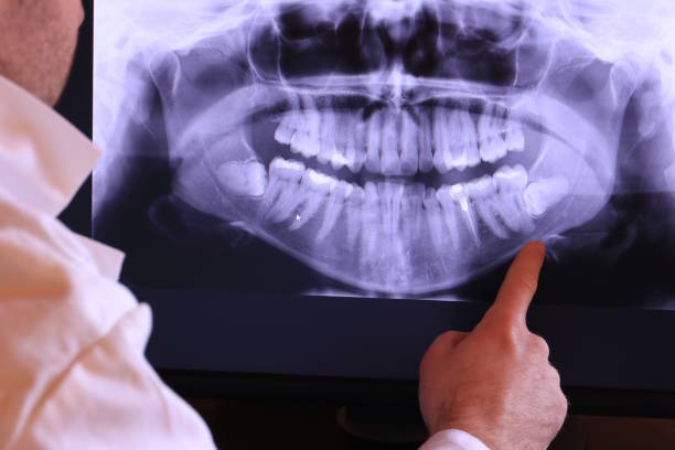 Best Emergency Root Canal Treatment in Cleves, OH